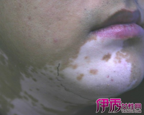 白癜风最新治疗方法揭秘，创新疗法助你摆脱白斑困扰